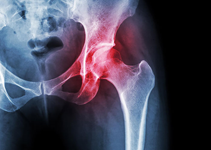 Georgia workers' compensation for an on-the-job hip injury